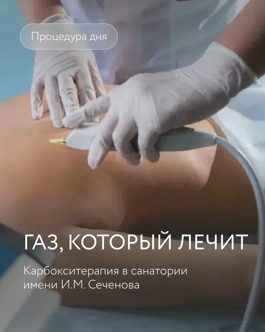 Карбокситерапия в санатории имени И. М. Сеченова: обновление тела изнутри