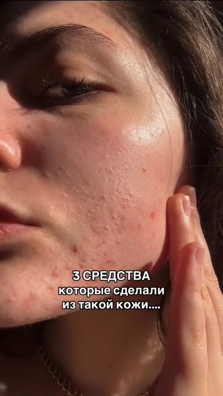 Эти сыворотки спасли мою кожу🙏🏼