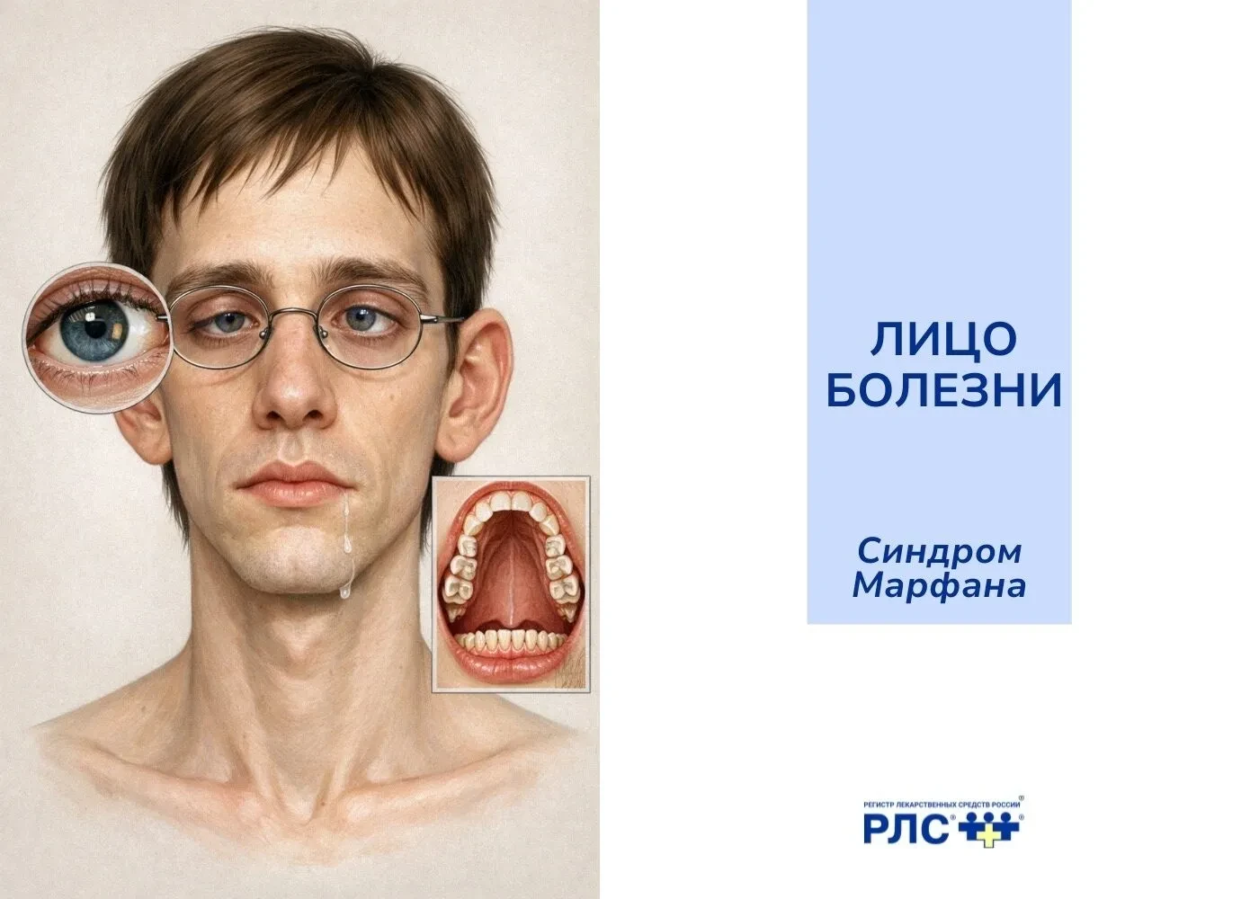 Синдром Марфана – наследственное заболевание соединительной ткани, вызванное мутацией г...