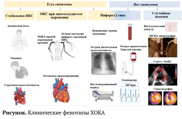📝 Как оценить показания к реваскуляризации и выбрать наиболее подходящий метод: главны...