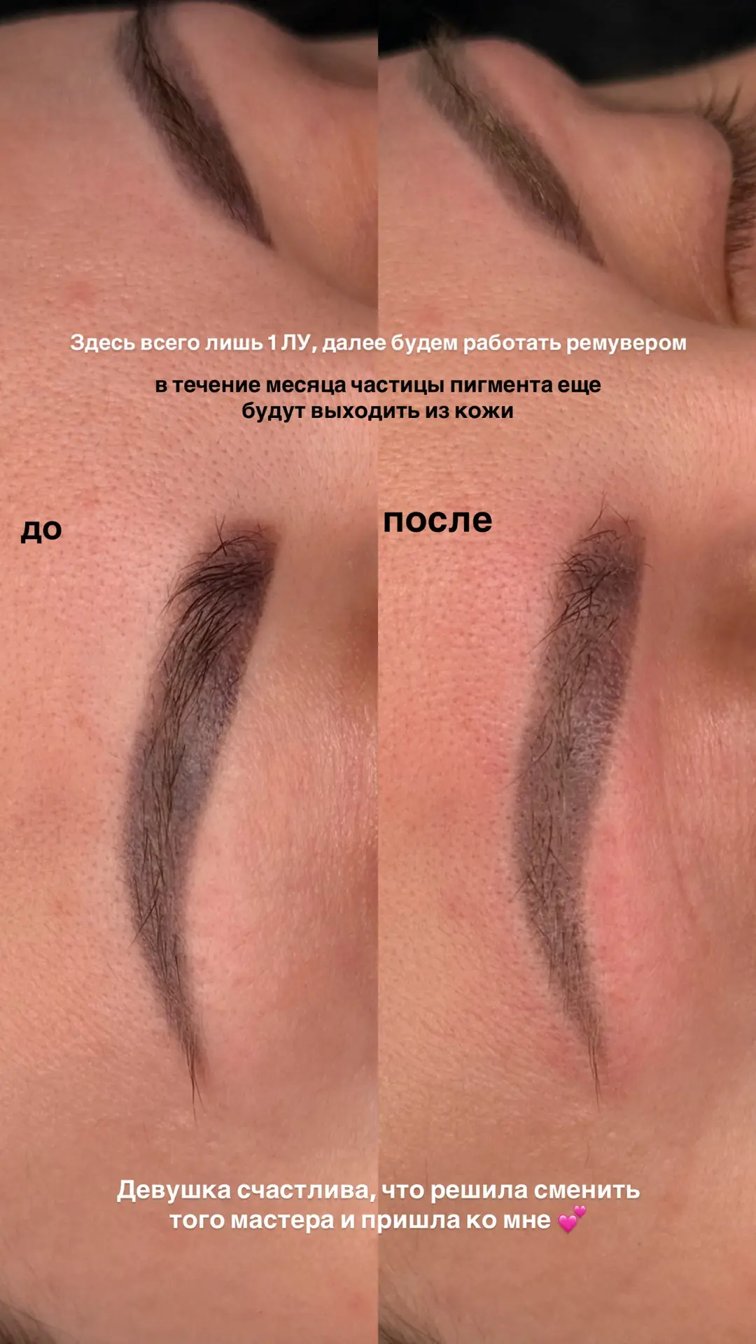 Девушка сходила на 6 лазерных удалений и было 0 результата…