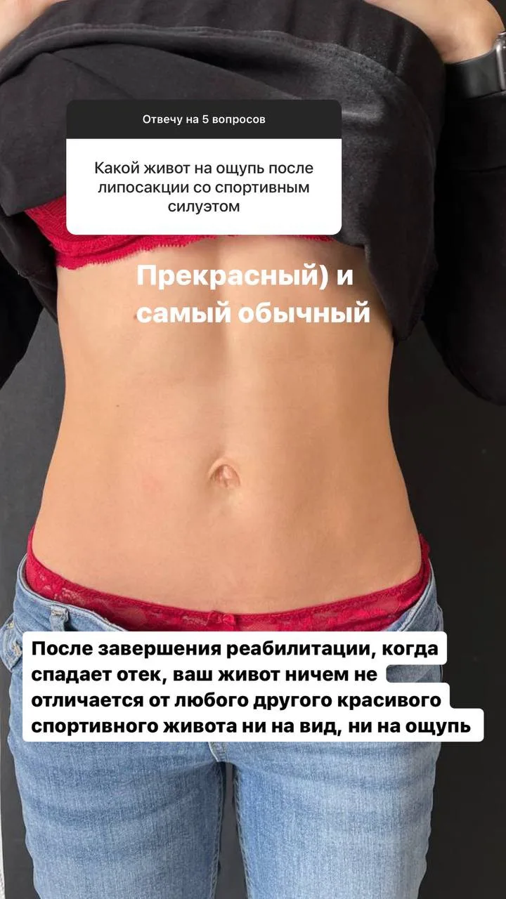 Какой живот на ощупь после липосакции? Отличный вопрос 👌🏻