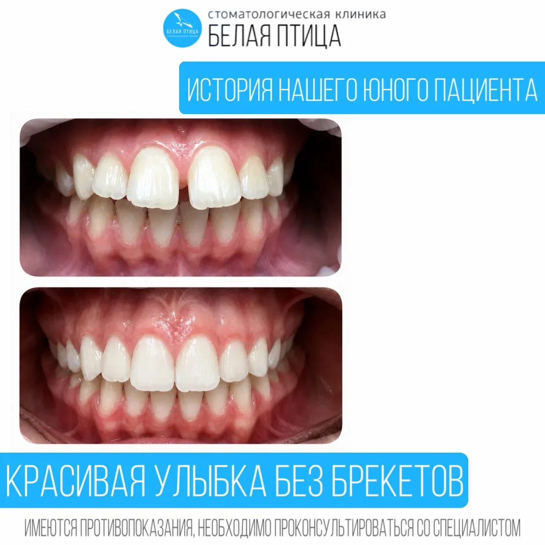 К нам обратилась пациент 14 лет с двумя основными проблемами: заметная щель между перед...