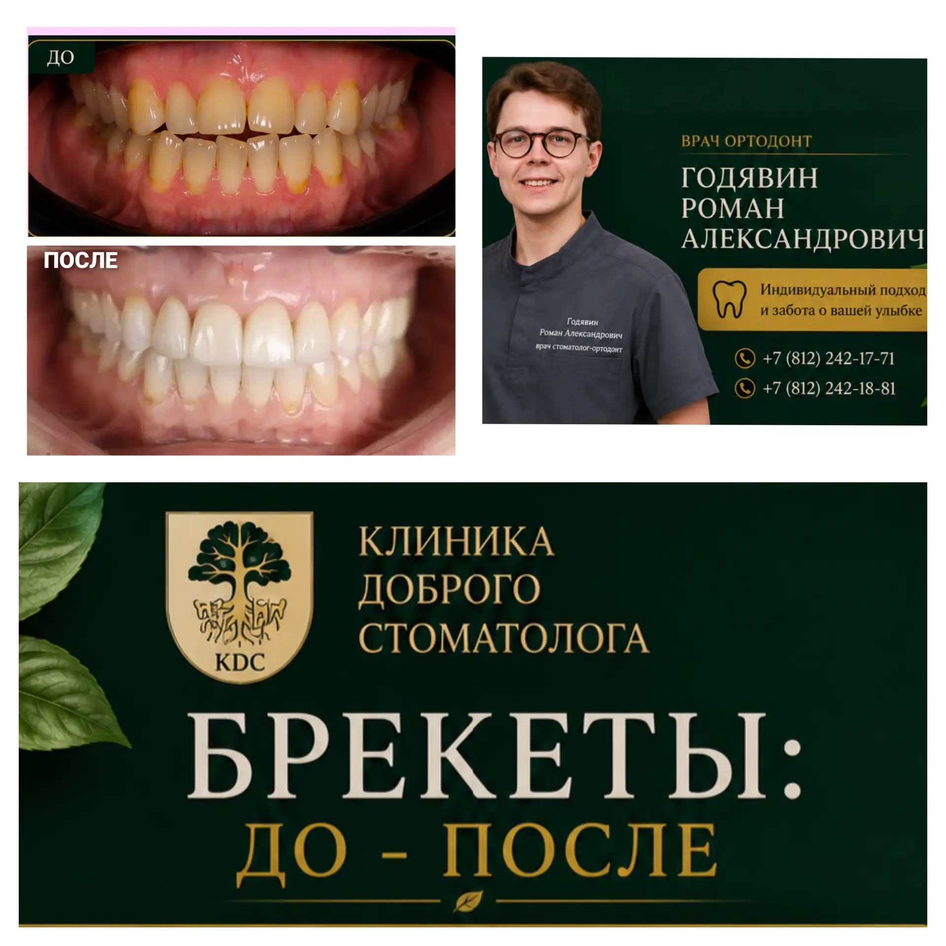 ✨ До и после ортодонтического лечения брекет-системой.

Правильный прикус — это не только красивая у