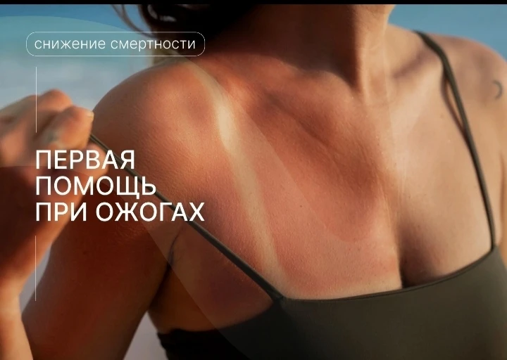 Первая помощь при ожогах