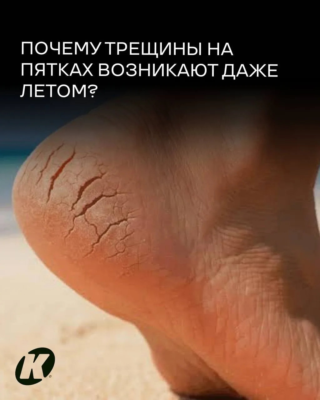 Почему трещины на пятках возникают даже летом?
