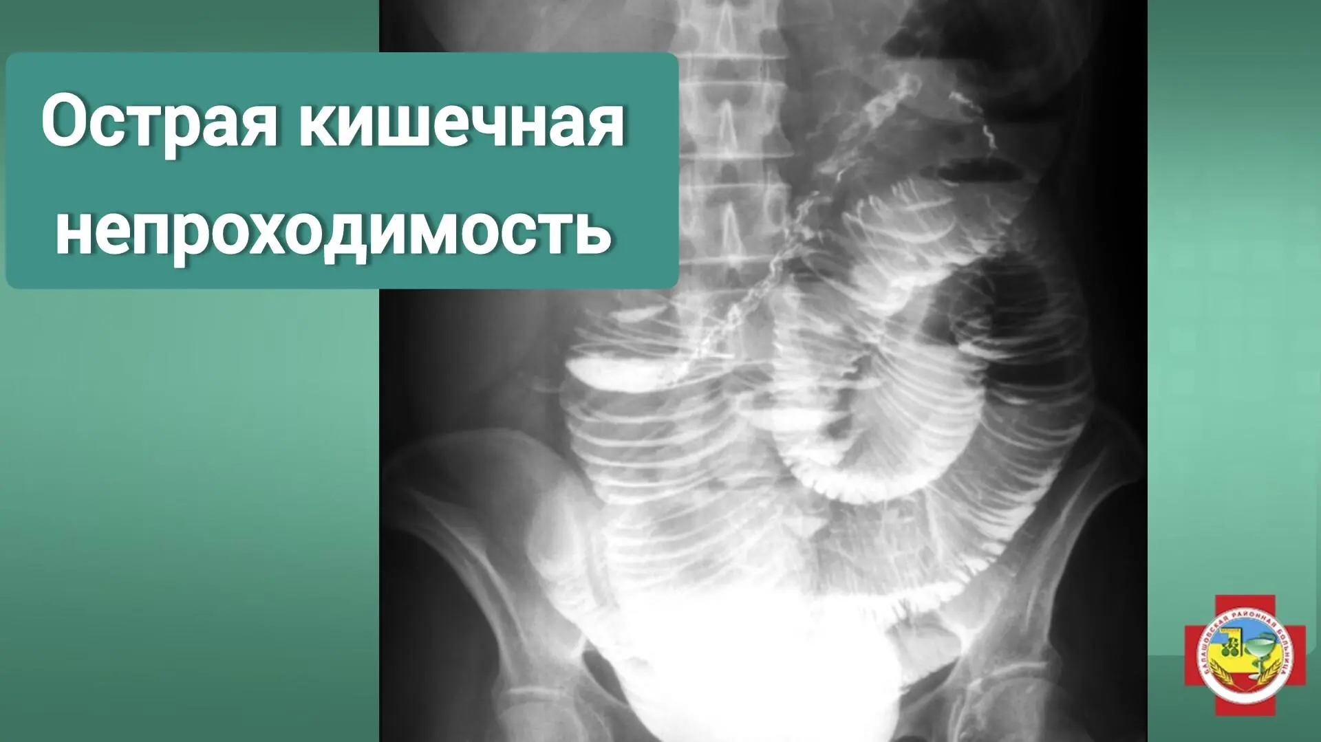 Кишечная непроходимость — это серьёзное состояние, которое требует немедленной медицинской помощи. Е
