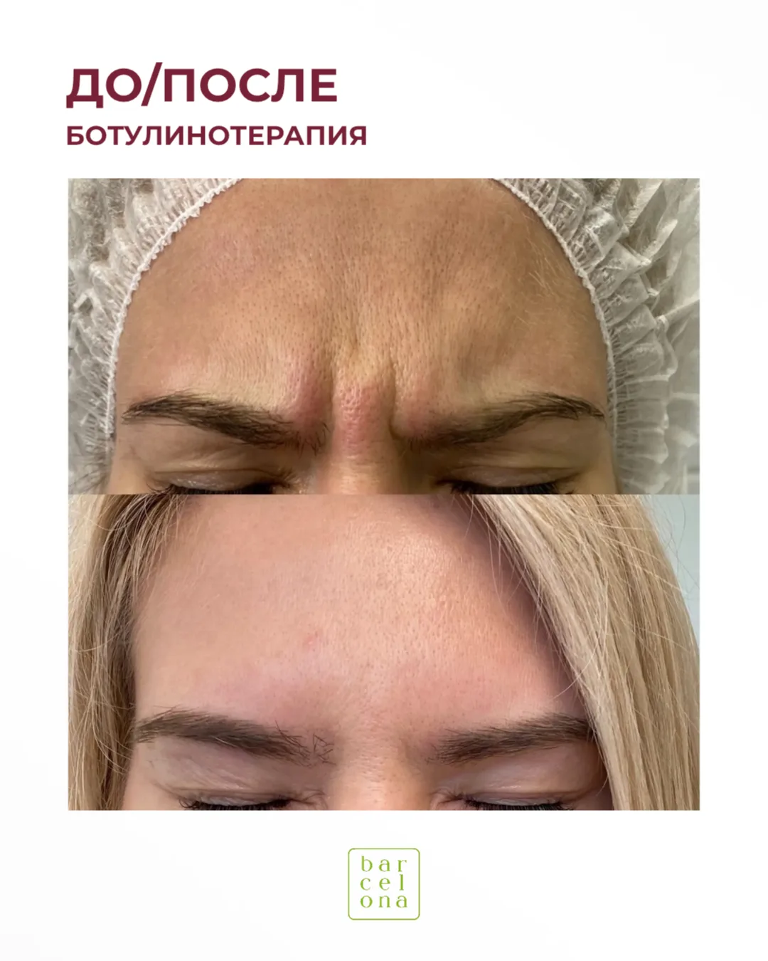 До/после: ботулинотерапия 💉