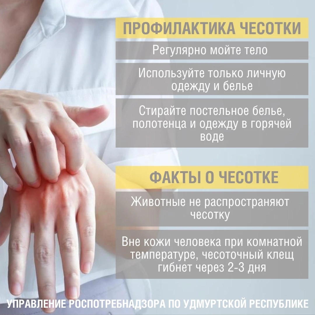 ☝🏻За 5 месяцев 2026 года в Удмуртии зарегистрировано 79 случаев заболевания чесотки.

🔹Чесотка – п