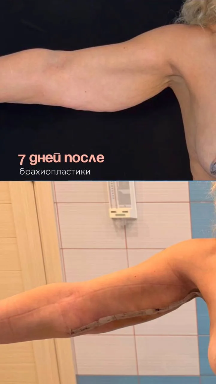 Результат брахиопластики на операционном столе и на 7 день после 🔥🔥🔥🔥