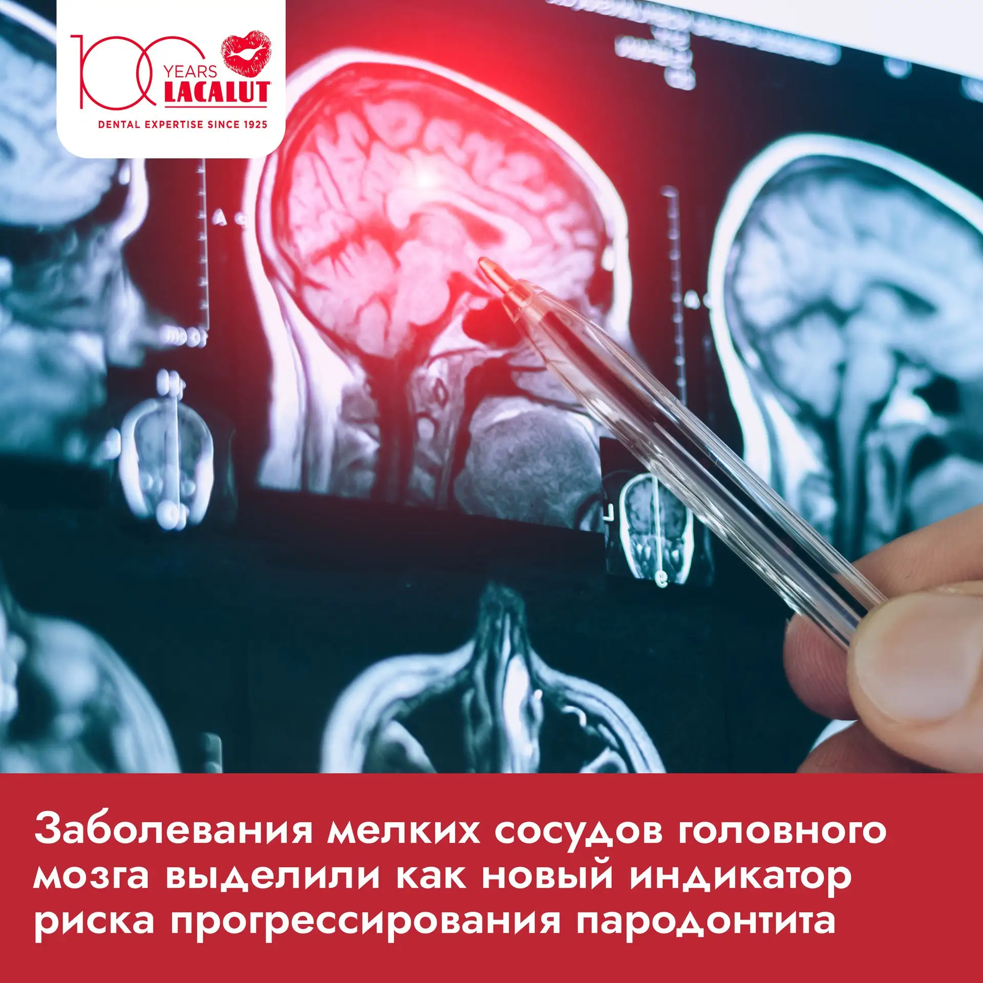 Пародонтит — одно из самых распространённых хронических заболеваний, занимающее шестое ...