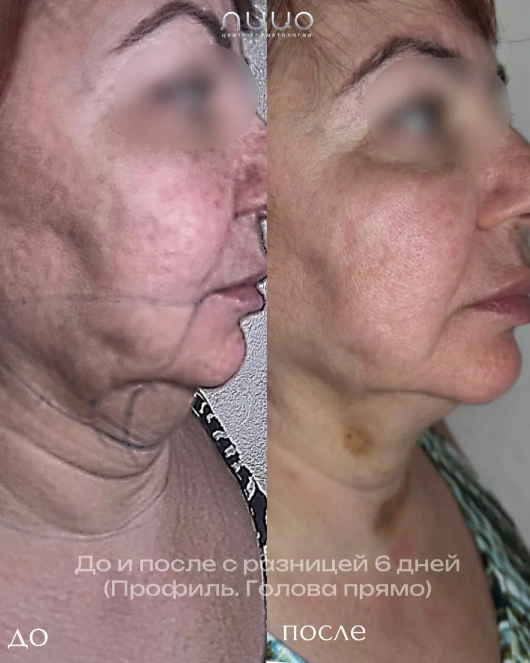 В моей практике часто бывает, что пациенты обращаются ко мне, разочаровавшись в каких-л...