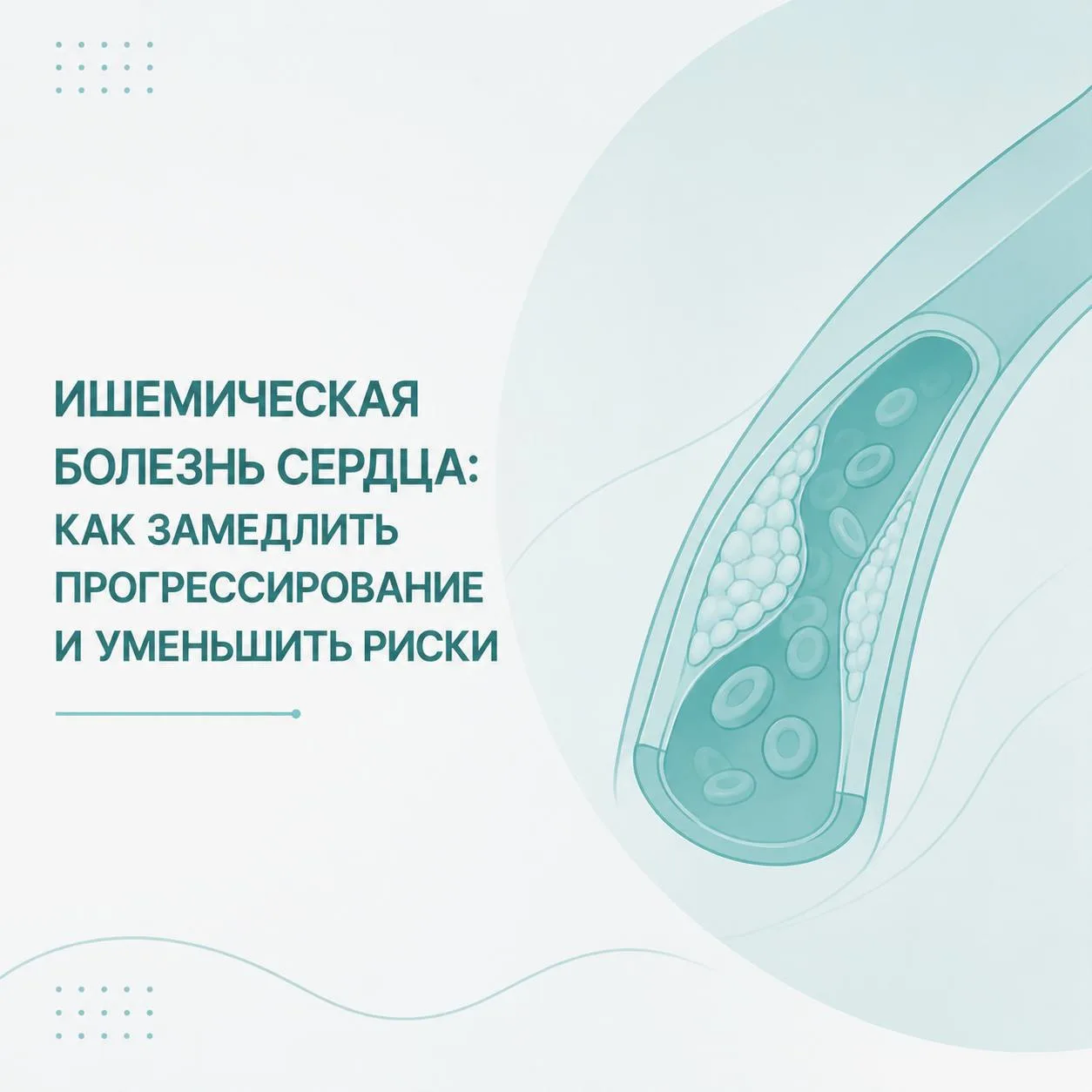 Ишемическая болезнь сердца: как замедлить прогрессирование и уменьшить риски

🫀 Внезапный инфаркт м