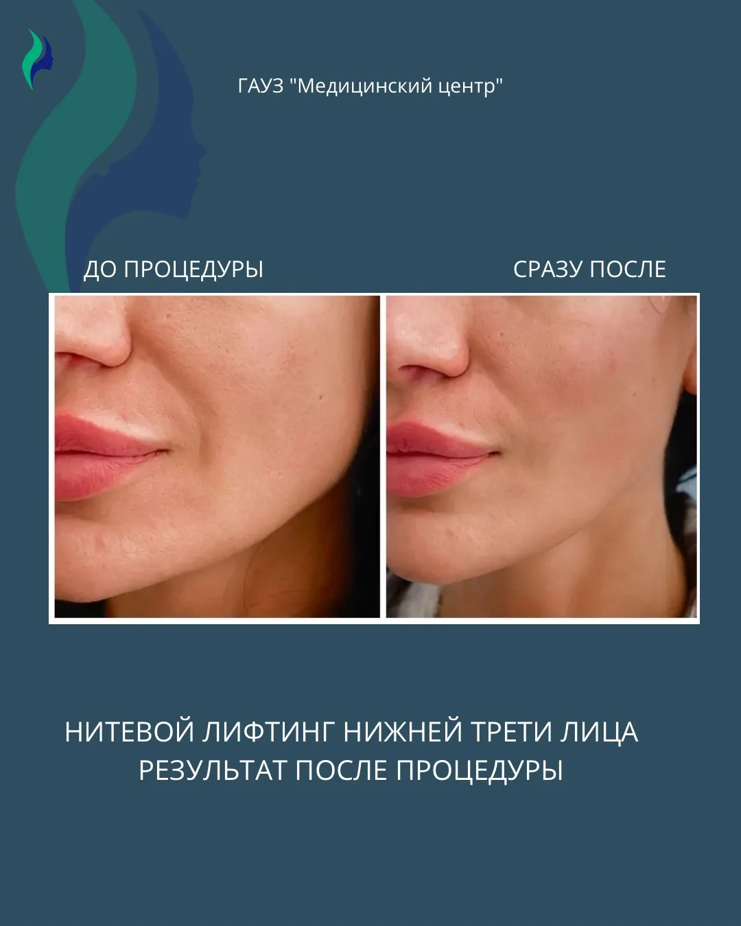 Кейс: нитевой лифтинг нижней трети лица