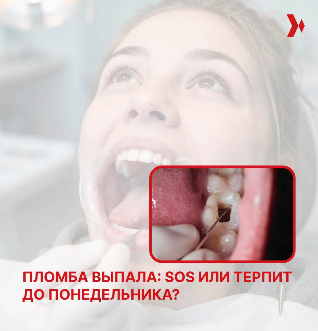 Пломба выпала: можно ли подождать до следующей недели? 🦷
