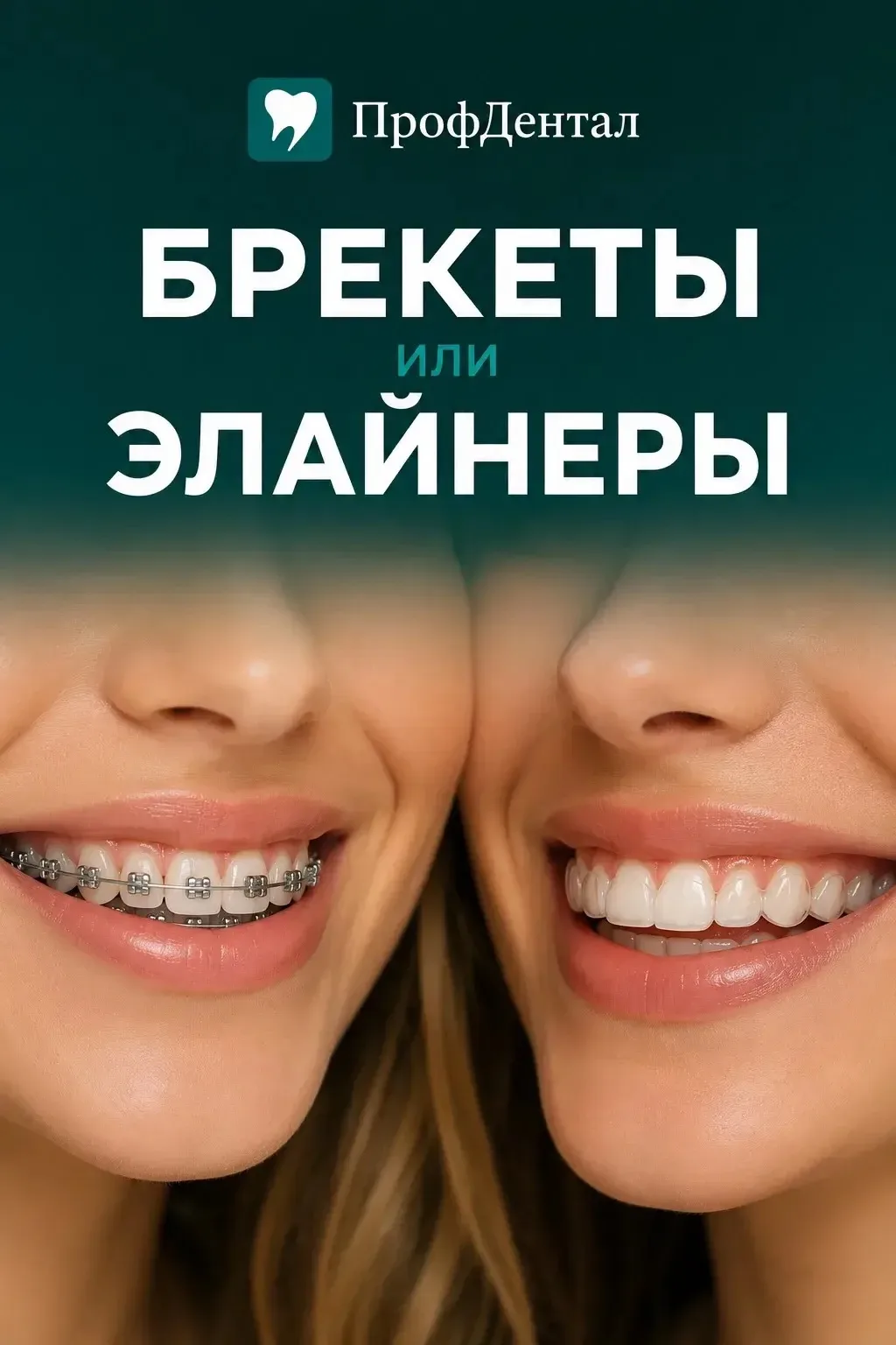 🦷 Невидимки для зубов: элайнеры или брекеты — что подойдёт именно вам?
