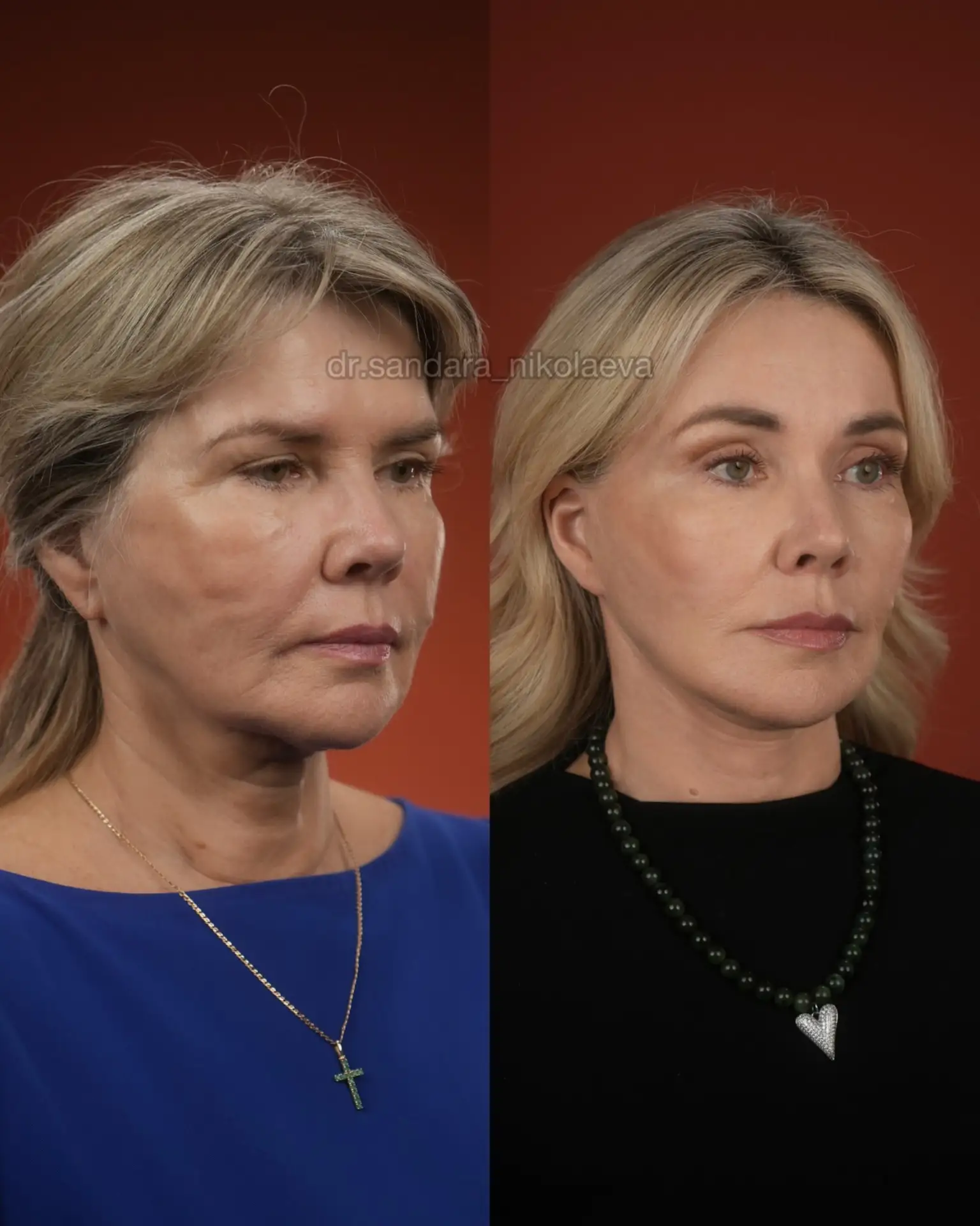 Сложный клинический случай. Повторная подтяжка. 65 лет.