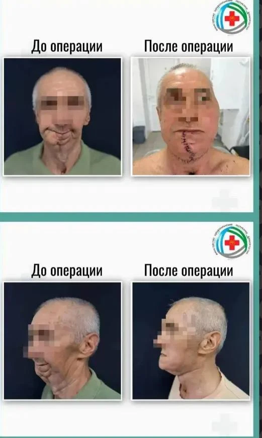 Российские врачи восстановили челюсть онкобольному.