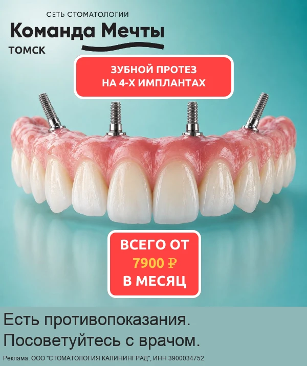 Несъёмное протезирование зубов на 4-х имплантах в Томске