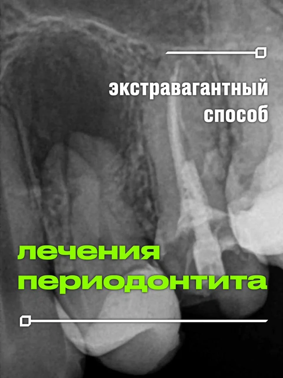 Сегодня покажу вам нетипичный для рутинной практики вариант лечения периодонтита: