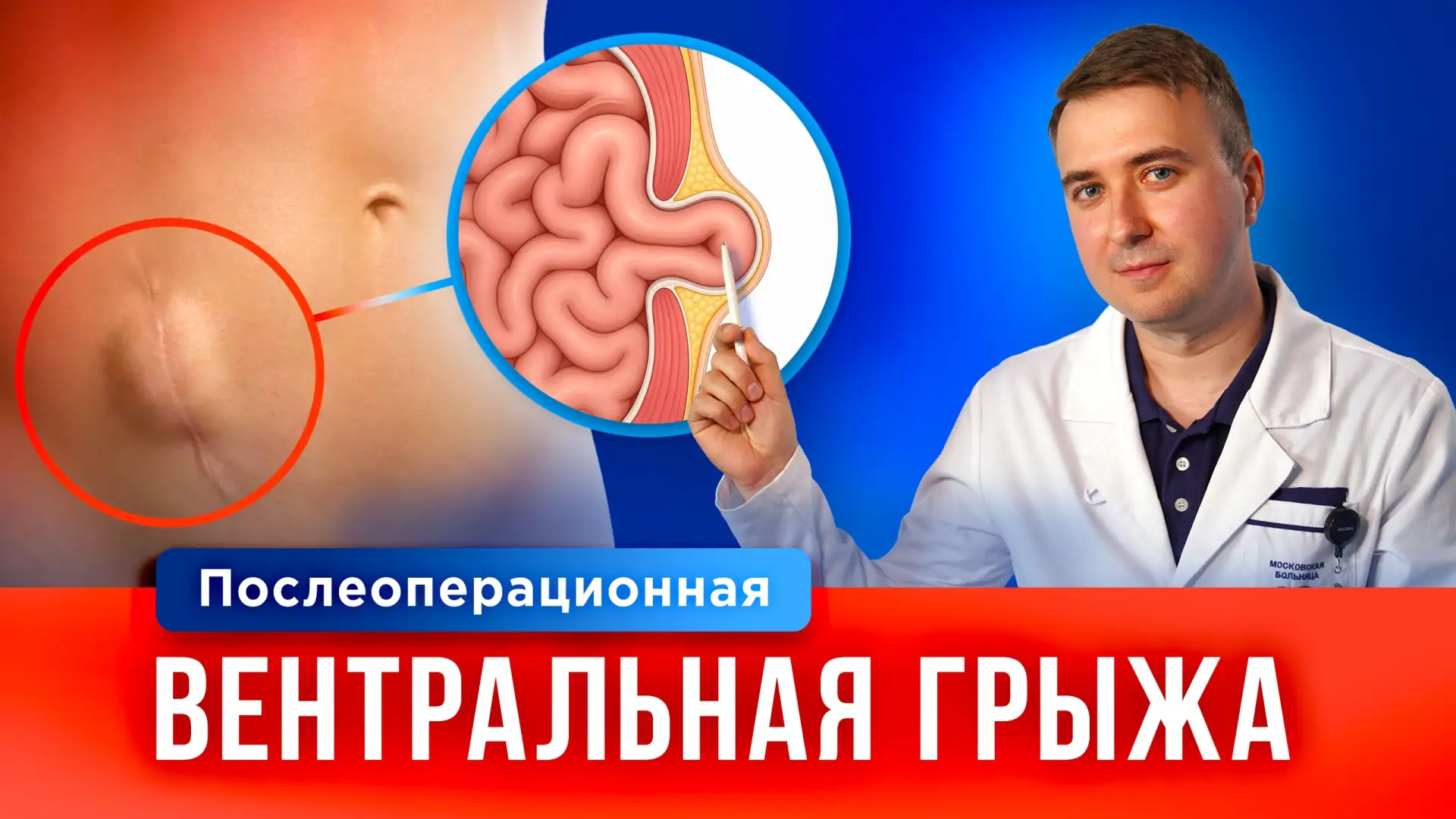 Как распознать и избавиться от грыжи живота? Врач о первых симптомах и бесплатной операции по ОМС

❓