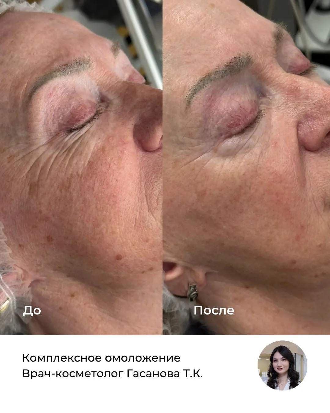 Промежуточный результат комплексного омоложения от врача-косметолога Тураны Камандаровн...