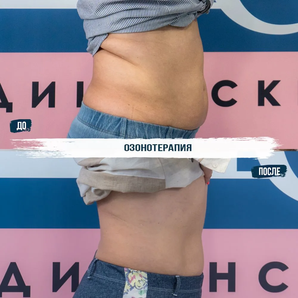 Второй подбородок и объемы в области талии, какие методы использовать? ✨