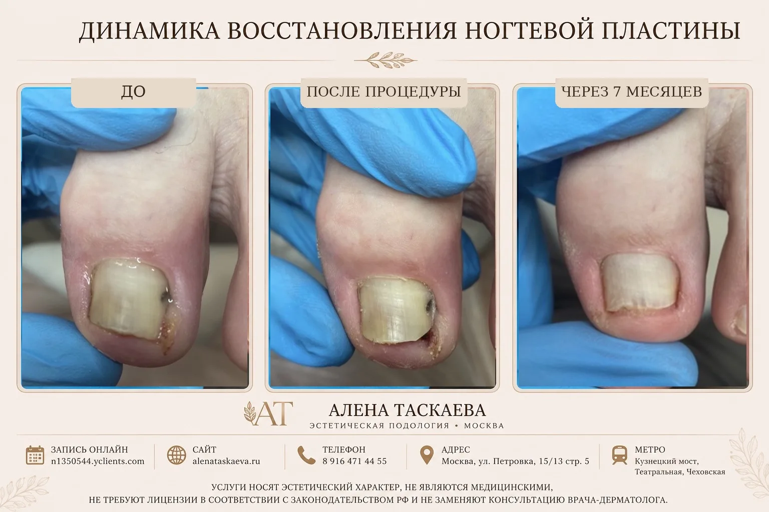 Когда причина дискомфорта — небольшой фрагмент ногтя