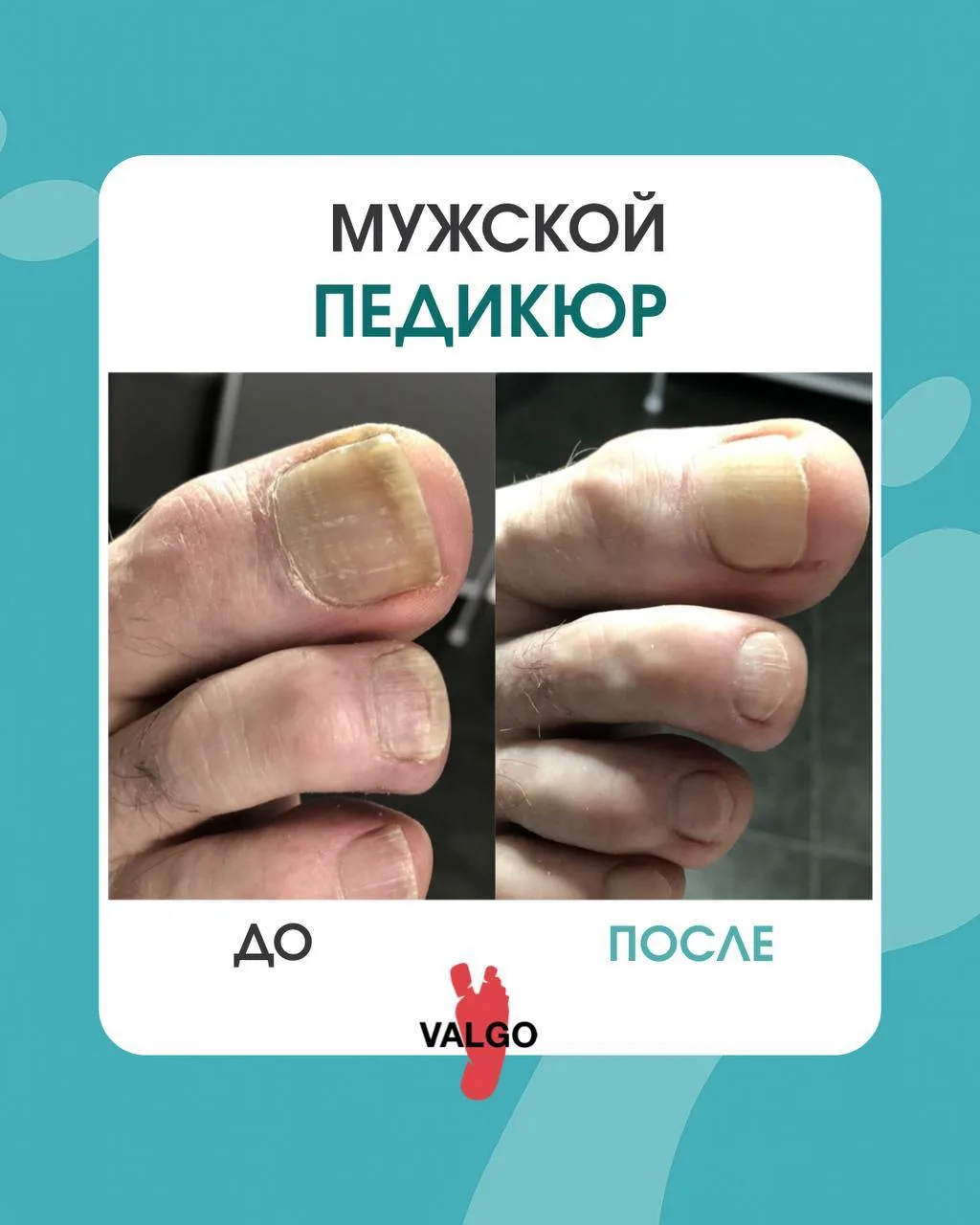 Многие мужчины откладывают уход за стопами до последнего — пока не появляется дискомфор...