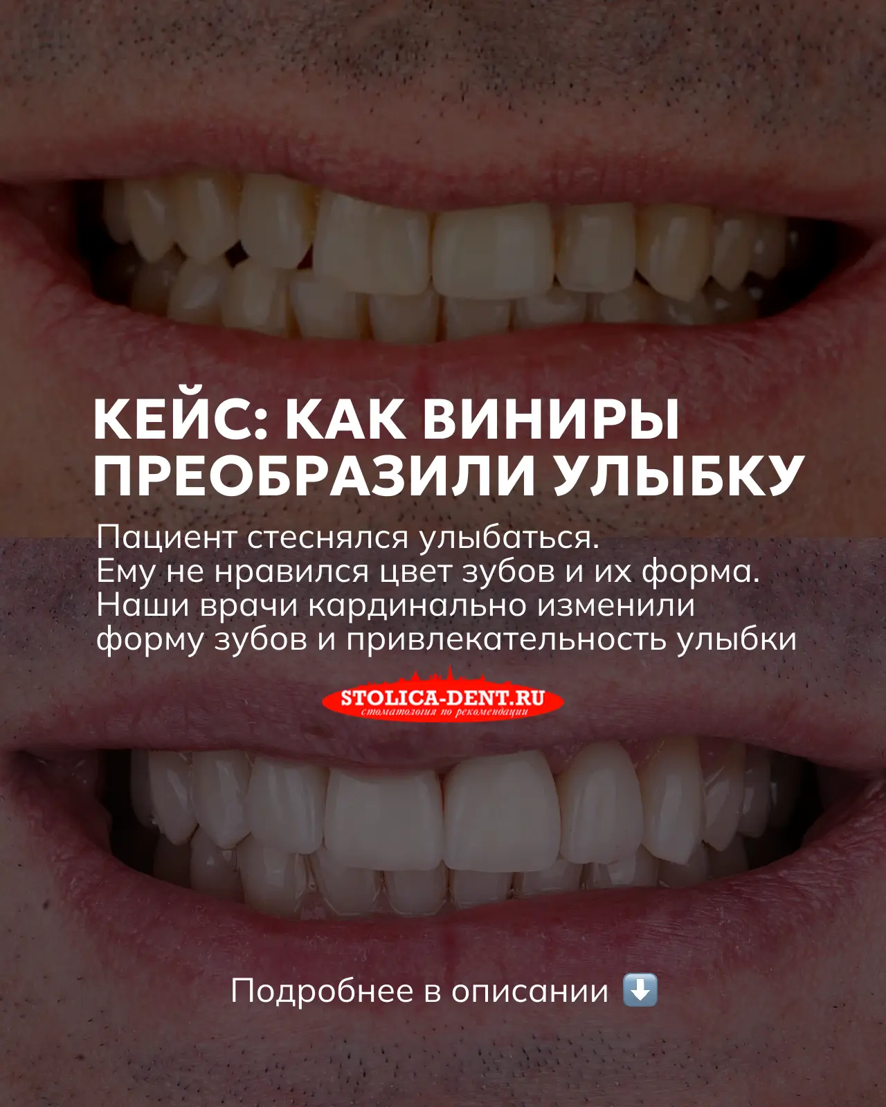 Кардинально поменяли улыбку пациенту мужчине средних лет за счёт 4х рефракторных виниров