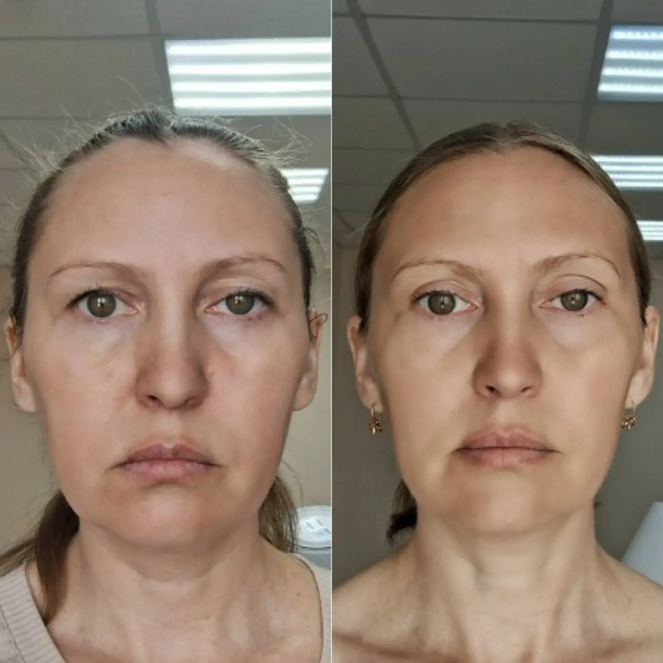 Очередная шикарная работа и минус 15 лет 🤩✨
Без операционное омоложение в секте Романенко 😎😎😎