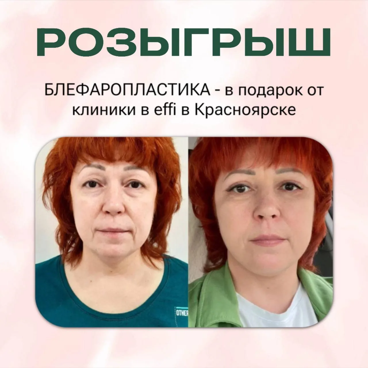 Дарим блефаропластику одной из вас 💋
