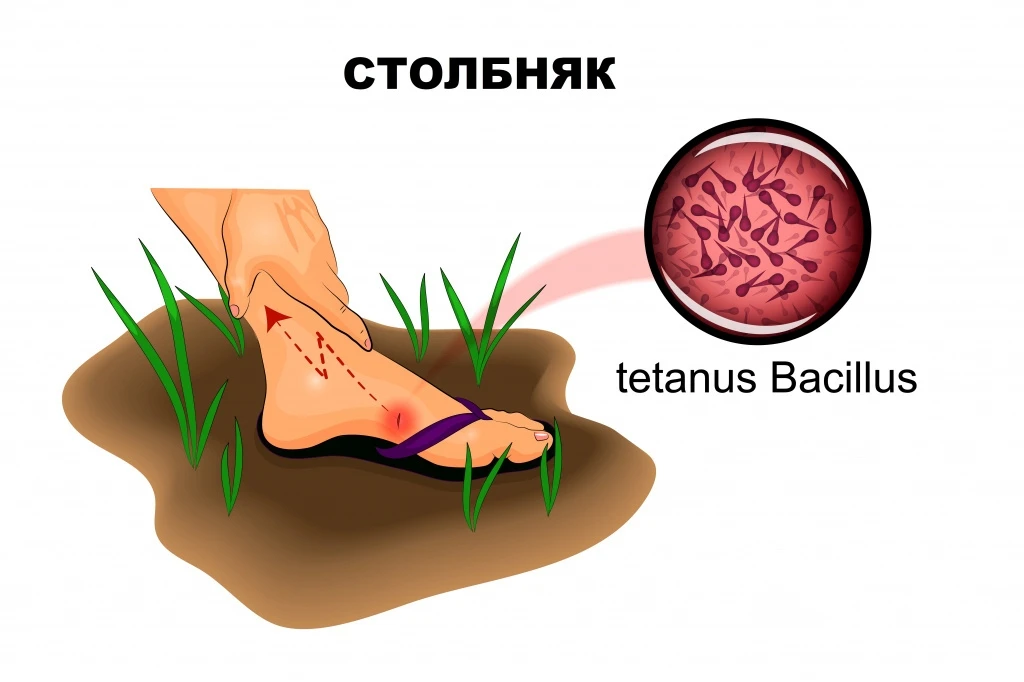 Столбняк, меры профилактики