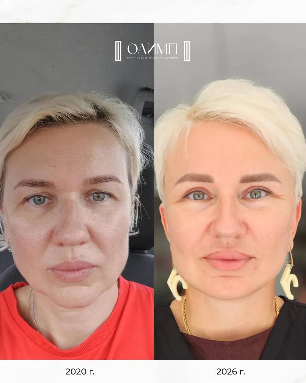 Была выполнена комплексная работа пластического хирурга и врача-косметолога в нашей кли...