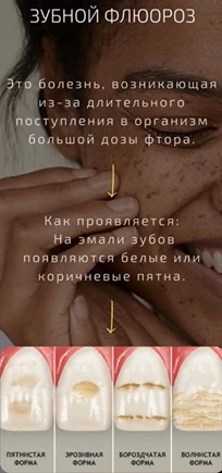 Все мы много раз слышали о том, что фтор полезен для зубов. И действительно, о положите...