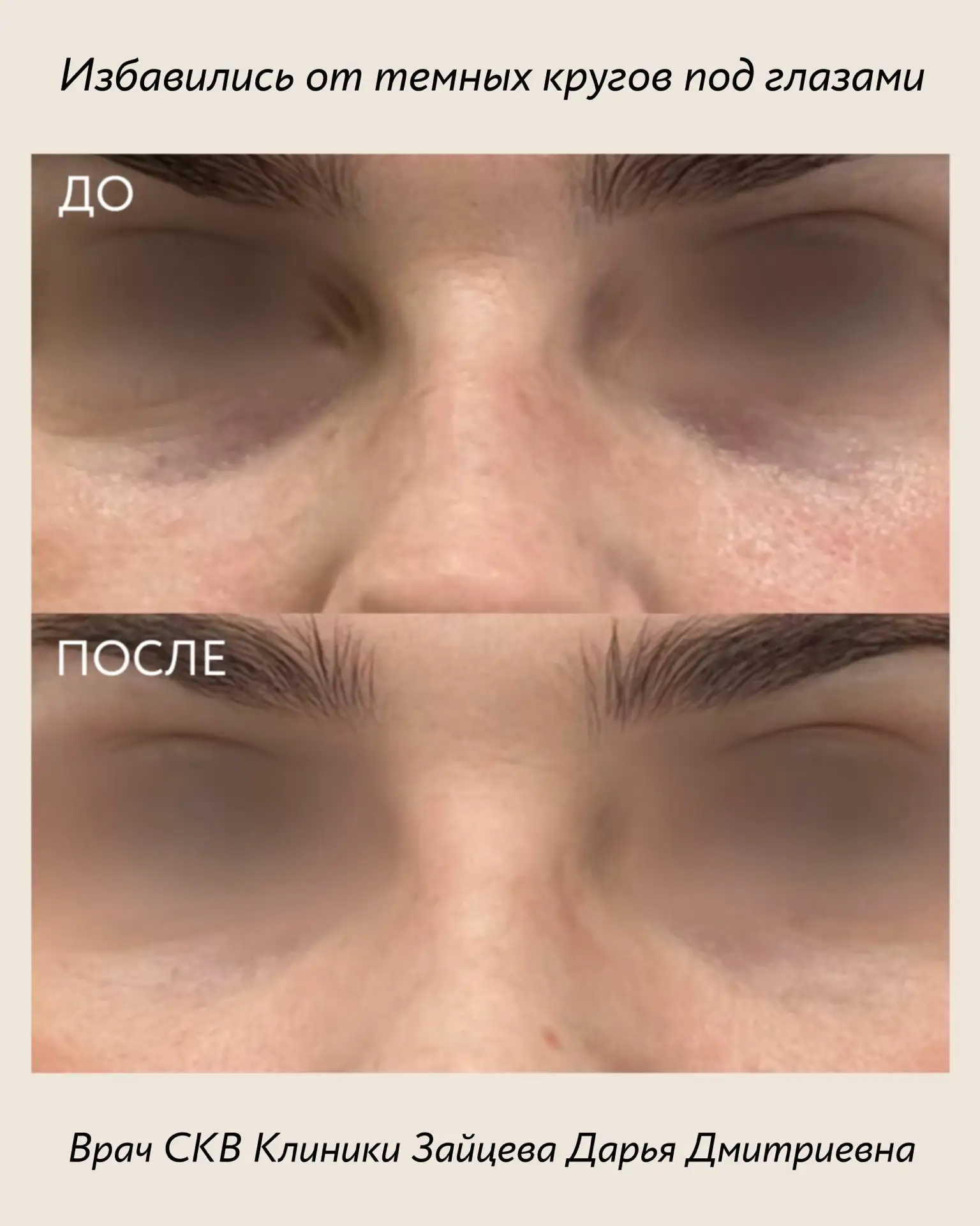 ПОЛИМОЛОЧНАЯ КИСЛОТА