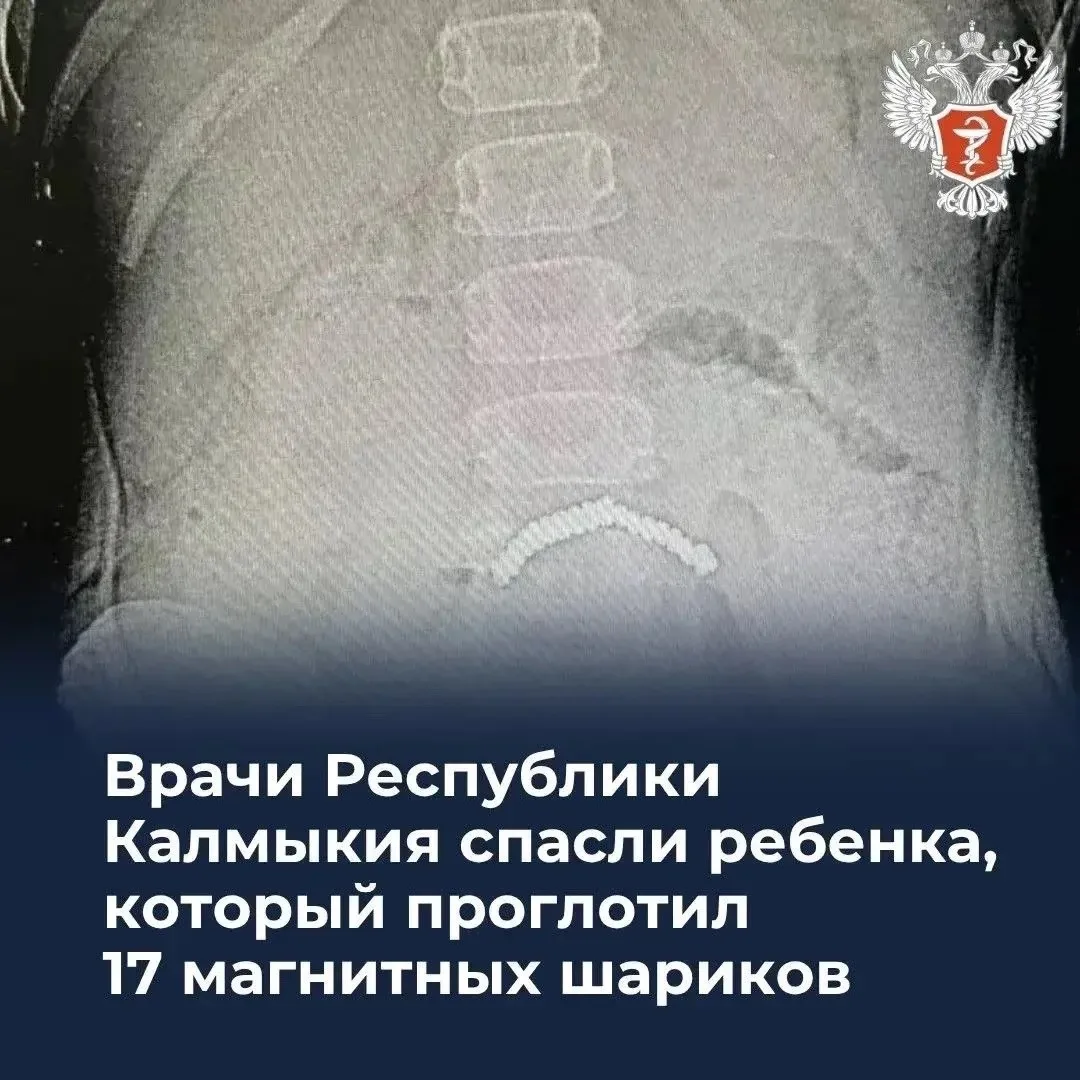 👶🏻 Врачи Республики Калмыкия спасли ребенка, который проглотил 17 магнитных шариков

7-летняя дево