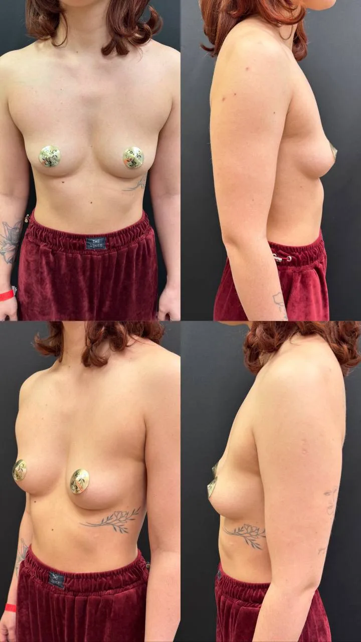 Полгода после увеличения 🍒 

Ваши фотоотзывы - отдельный вид эстетического удовольствия 🤌🏼

Для д