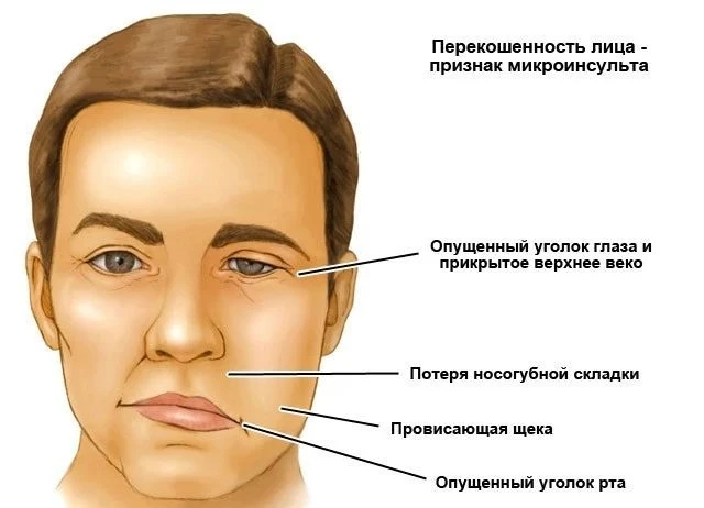 Признаки микроинсульта👇