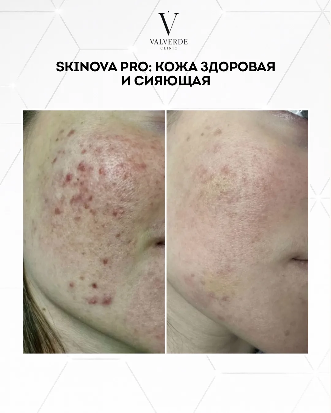 Результат после курса Skinova Pro LDM ✨