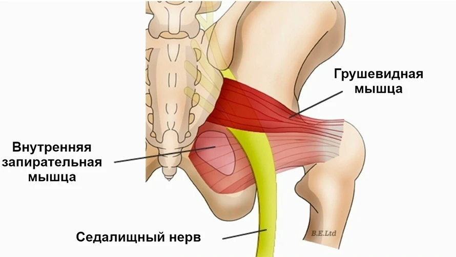 Синдром грушевидной мышцы: как избежать боли в ноге