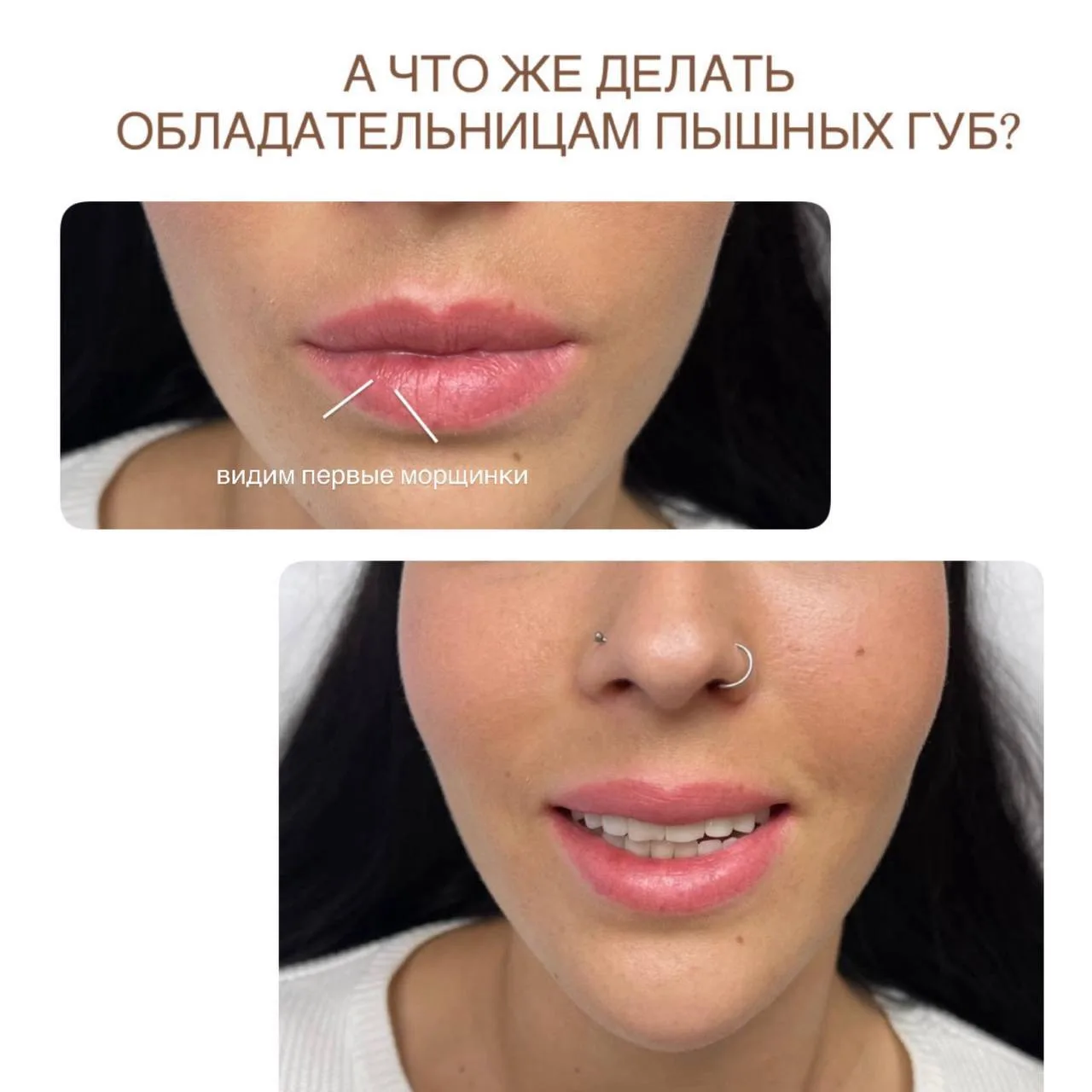 А что же делать обладательницам пышных губ, если мы в нашей клинике придерживаемся нату...