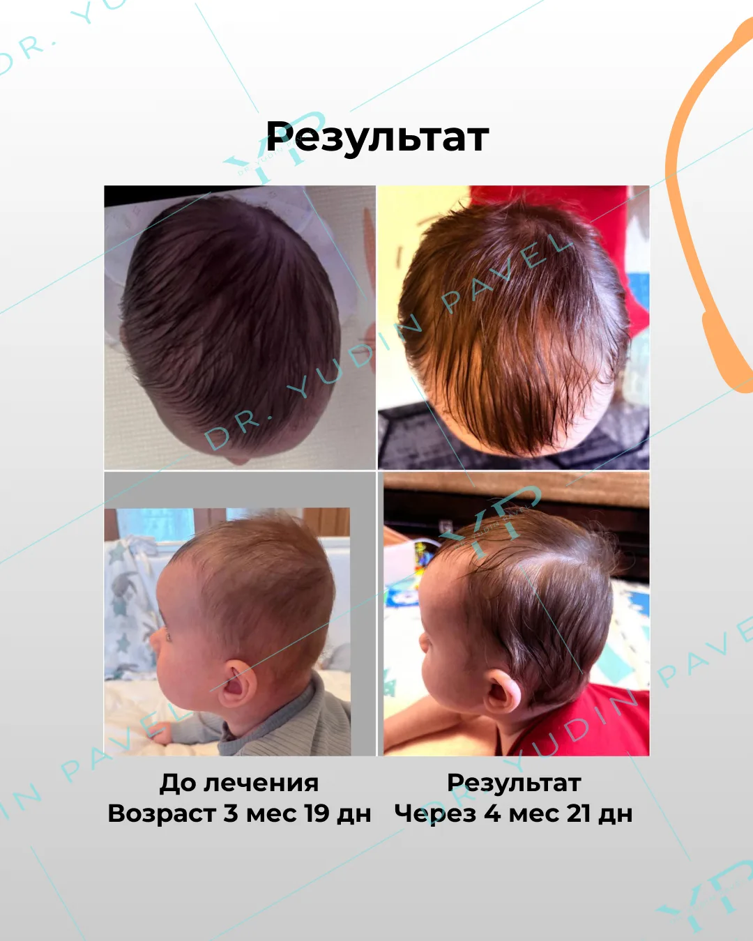 Делимся ещё одним отличным результатом лечения в шлеме ОРТОТИС! 🎉
