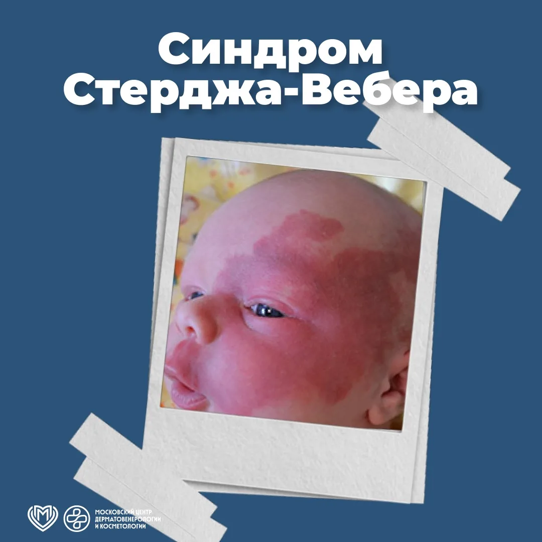 ✅ Сегодня снова поговорим о редком заболевании, с которым встречаются наши врачи в своей практике – 