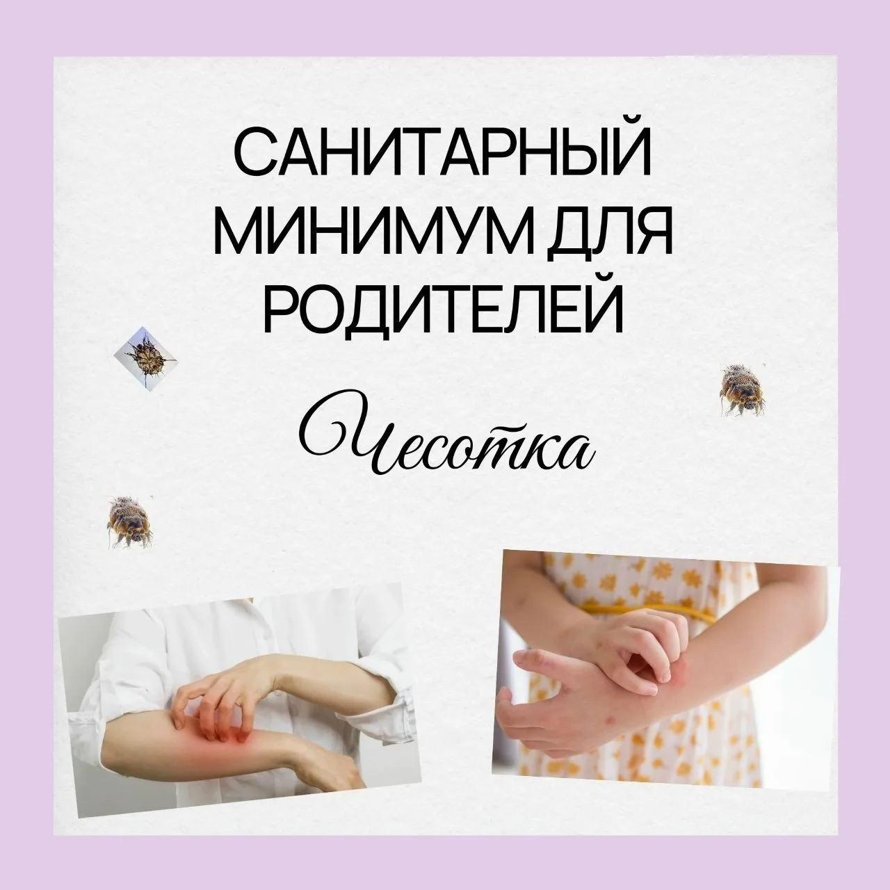 САНИТАРНЫЙ МИНИМУМ ДЛЯ РОДИТЕЛЕЙ. Выпуск 6: Чесотка — как не привезти из лагеря
⁣
Зуд усиливается к 
