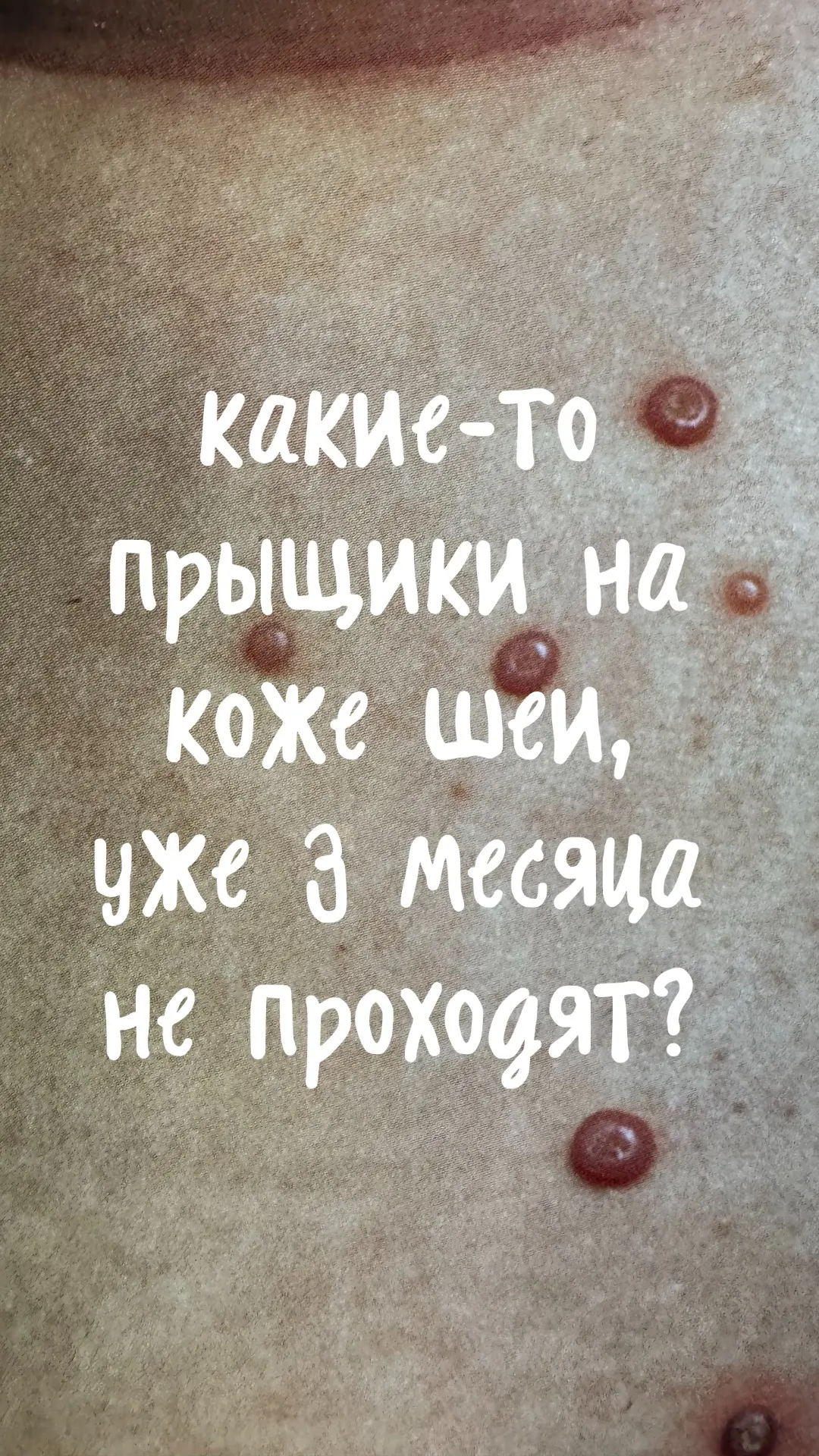 «Доктор, у меня какие-то прыщики на коже шеи, уже 3 месяца не проходят» 🧐

На приёме — бабушка. Тол