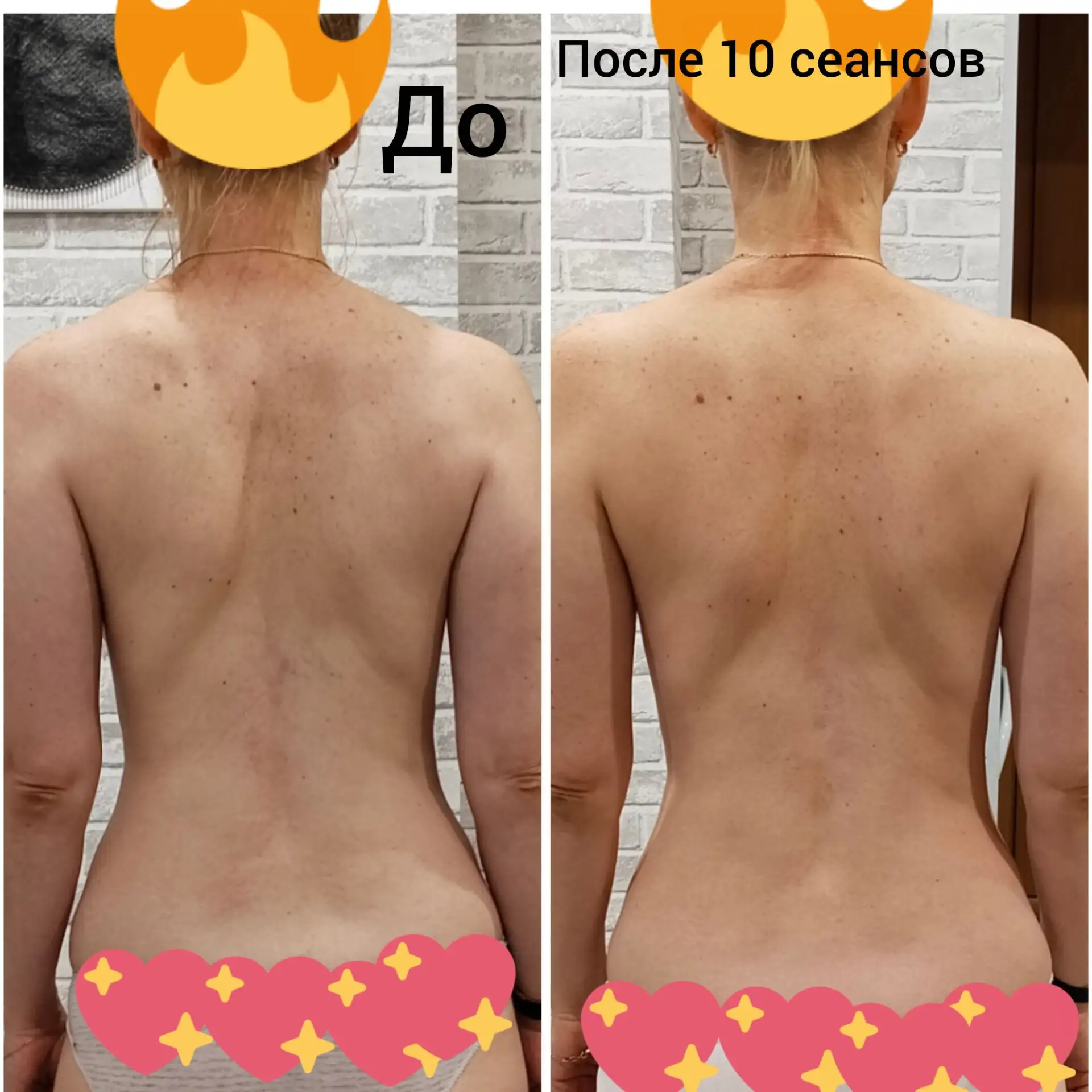 Всем привет. Вчера провела 10 сеанс миофасциального массажа тела. Делюсь результатами.