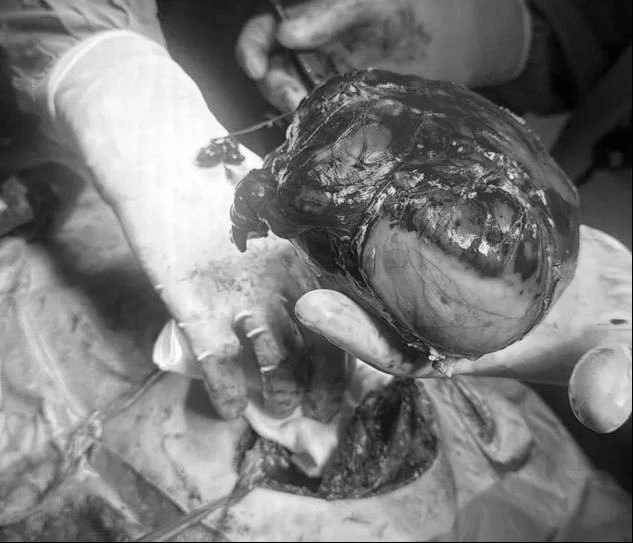 👨‍⚕️ В Центре Рошаля успешно прооперировали девочку из Калининграда с гигантской опухолью вилочково