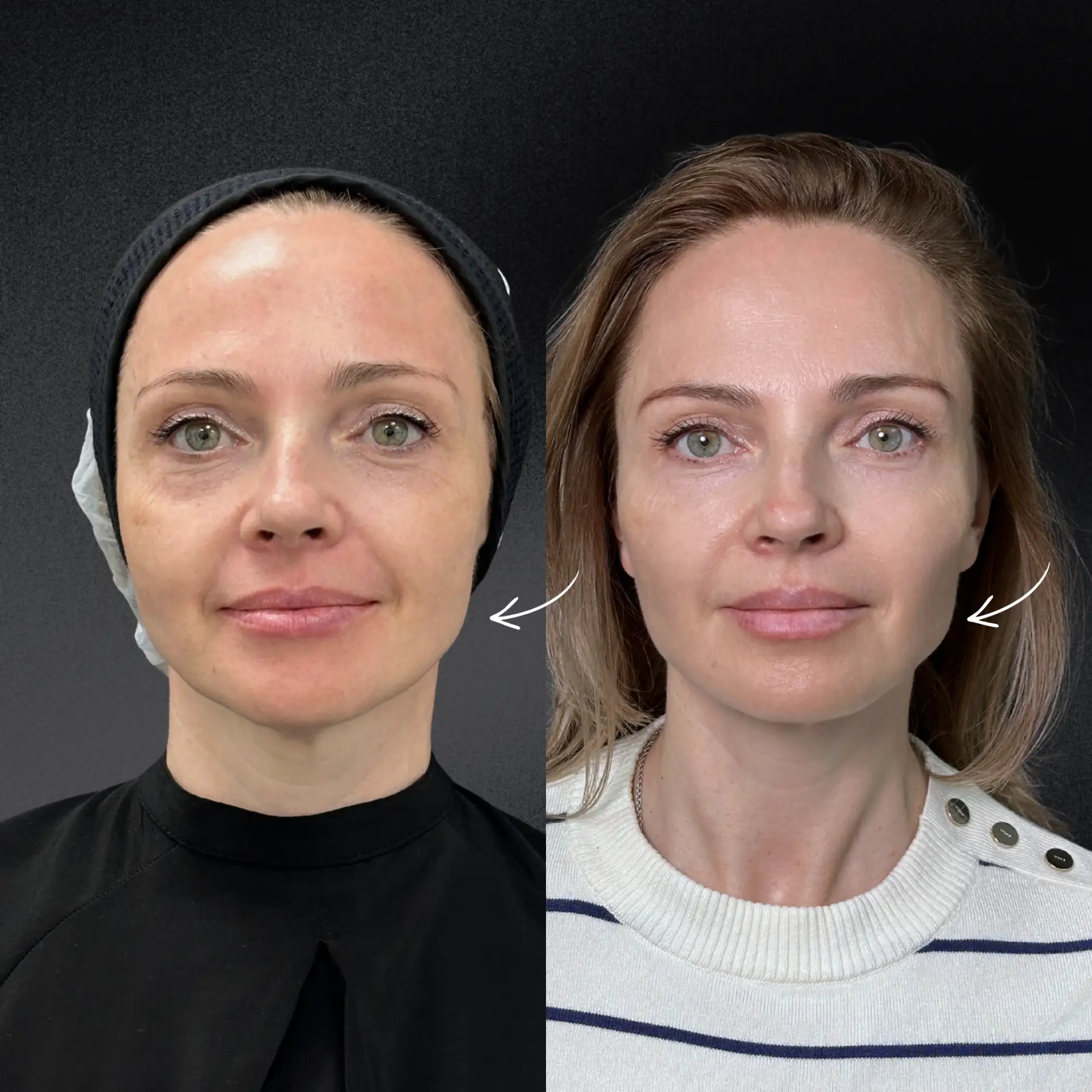 До и после: работа с Ozempic face