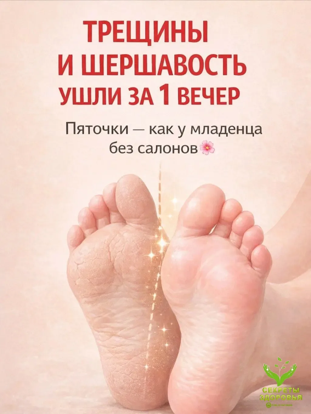 Пяточки, как у младенца — без салонов 👣 Трещины, сухость и шершавость уходят уже после первой процед